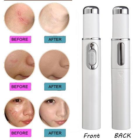 Blue Light Acne Therapy Laser Pen